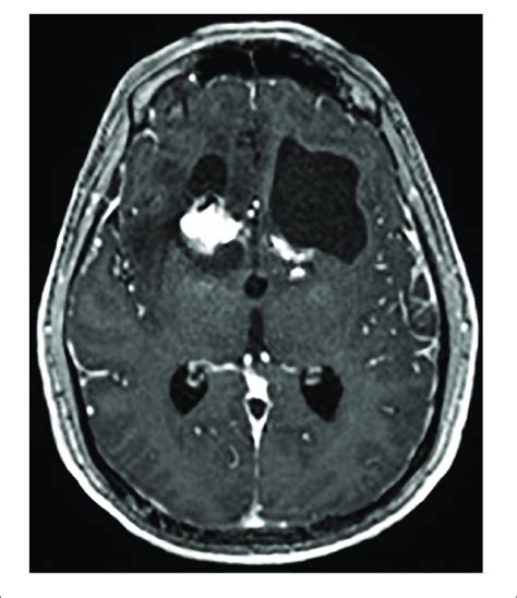 Axial T1 Weighted Mri With Contrast Of Brain Cyst In The Left