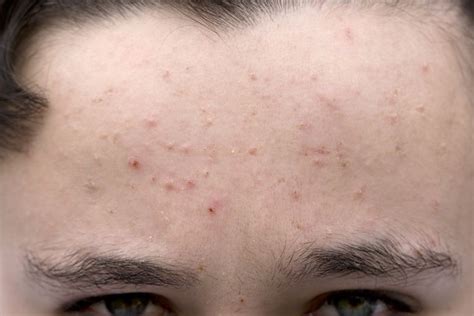 Forehead Acne Removal Naturally Best Tips Healthpulls