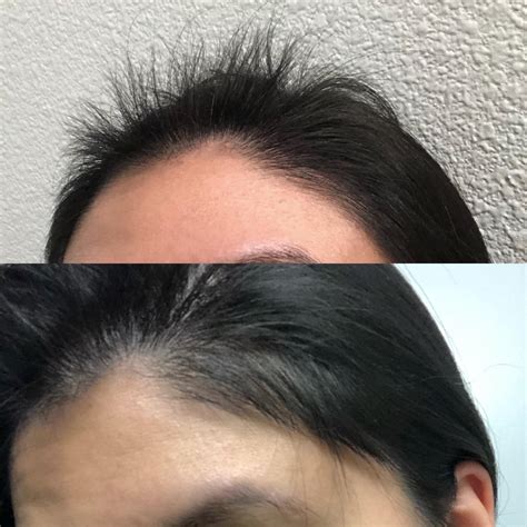 For Anyone Also Going Through Postpartum Hair Loss — Dont Lose Hope I Wanted To Share Pics Of