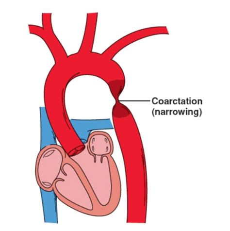 Surgical Recall Cardiovascular Surgery Flashcards Quizlet