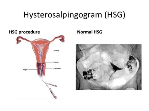 What Is Hsg Hysterosalpingography All You Need To Know