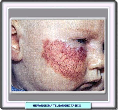 Albums 97 Pictures Strawberry Hemangioma Before And After Pictures Sharp