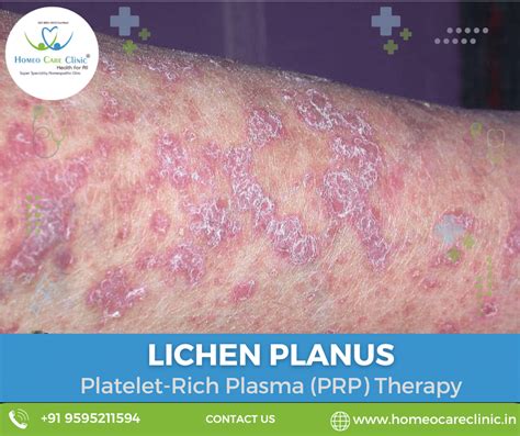 Lichen Planus Symptoms Causes And Advanced Prp Therapy Solutions