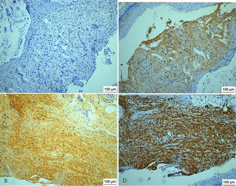 Immunohistochemical Analysis A Immunohistochemical Analysis Revealed