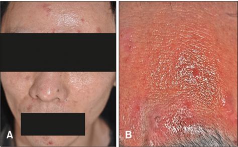 A Erythematous Indurated Papules And Pustules Of Varying Sizes