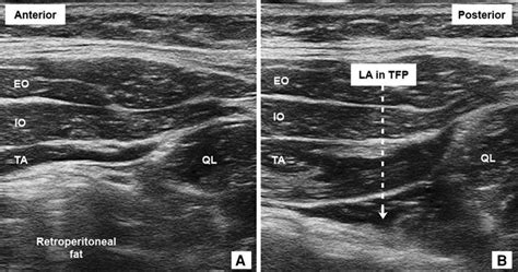 Ultrasound Guided Transversalis Fascia Plane Block Provides Analgesia For Anterior Iliac Crest