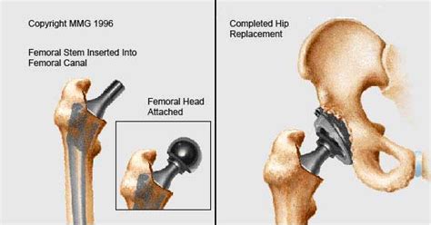 Cemented Vs Uncemented Hip Replacement Aldecoaroegner 99