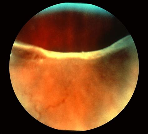 Retinal Dialysis - Retina Image Bank