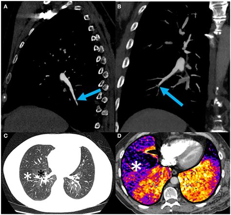 Frontiers Chronic Thromboembolic Pulmonary Hypertension Secondary To