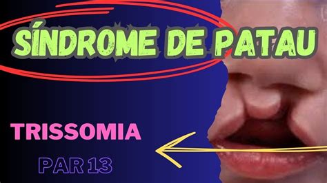 S Ndrome De Patau Trissomia Do Cromossomo Muta O Cromoss Mica