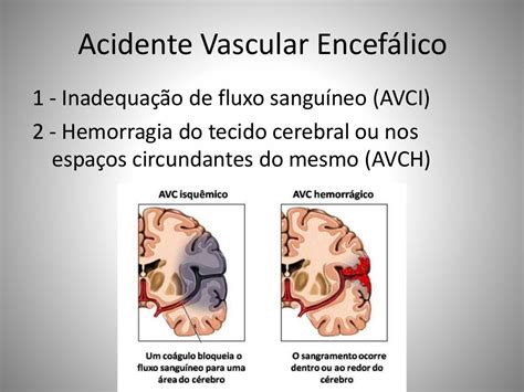 Analise As Afirmativas Sobre Acidente Vascular Encefálico - Acidente Vascular Encefalico Fisiopatologia - RETOEDU