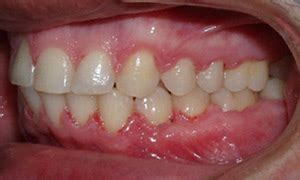 Before And Afters Pearland Orthodontics Pearland TX