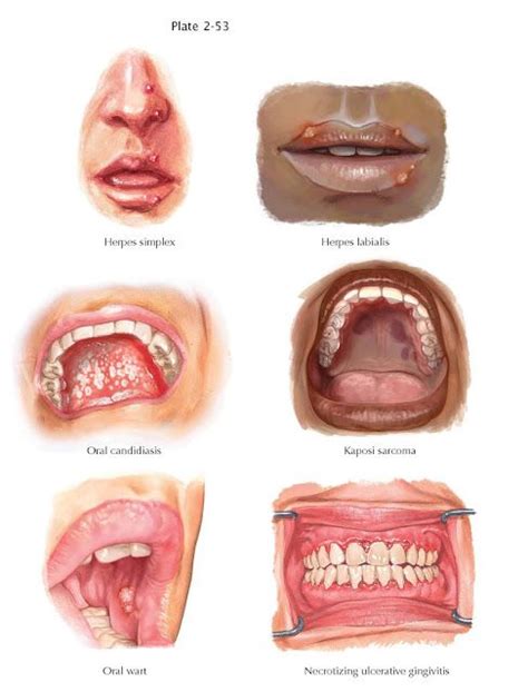 Oral Manifestations Of Immunocompromised Conditions