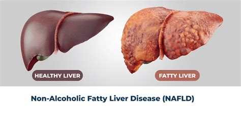 Homeopathy Treatment Of Fatty Liver Disease Best Homeopathy Doctor In India Us Uk Europe