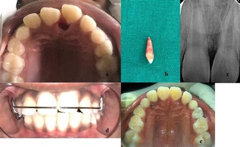 -(2a) Atraumatic extraction of supernumerary tooth,(2b) Extracted ...