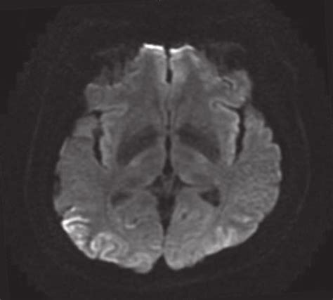 Brain MRI DWI Cortical Ribboning Restricted Diffusion Signal