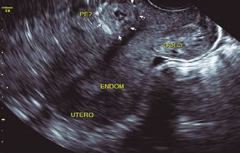 A Import Ncia Da Ultrassonografia Gestacional De Primeiro Trimestre