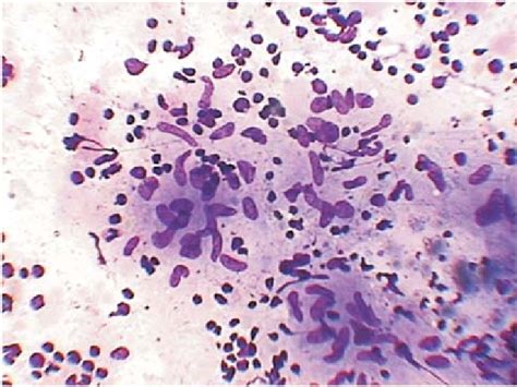 Microphotograph Of Fnac Lymph Node Smear Showing Granuloma Mgg Stain Download Scientific