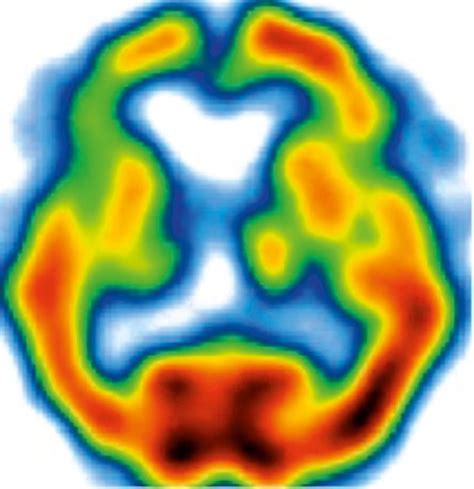 Corticobasal Degeneration [99mtc] Hmpao Spect With Asymmetric Download Scientific Diagram