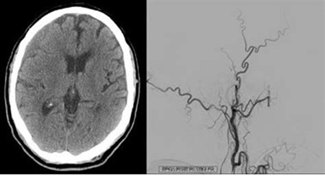 E 100 Middle Meningeal Artery Embolization For The Treatment Of Chronic