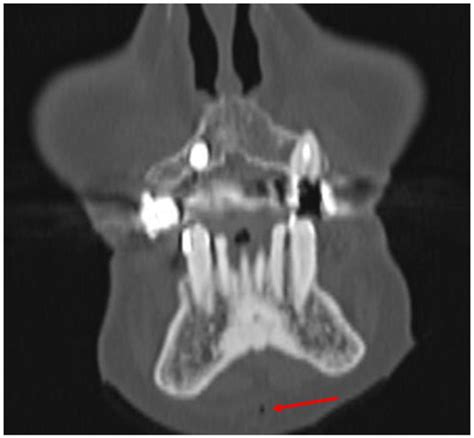 Diagnostics Free Full Text Air Sign In Misdiagnosed Mandibular