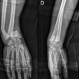 Patient Antero Posterior And Lateral Radiographs After Surgery