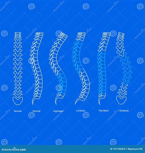 Osteoporosis Bone Types Infographics Concept Card Poster Contour Linear