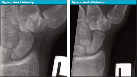 Management Of Scaphoid Injuries With Early Specialized Imaging At