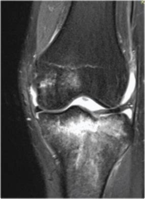 Bone Bruise Knee Mri