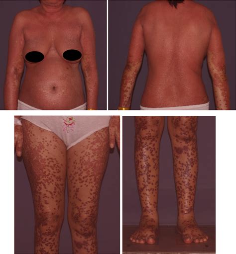 Figure From Torch Re Activation Concomitant With Drug Induced Torch