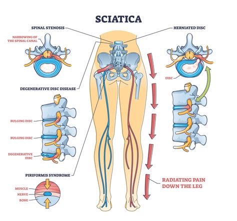 What You Should Know About Sciatica and Spinal Stenosis : The Hearty Soul