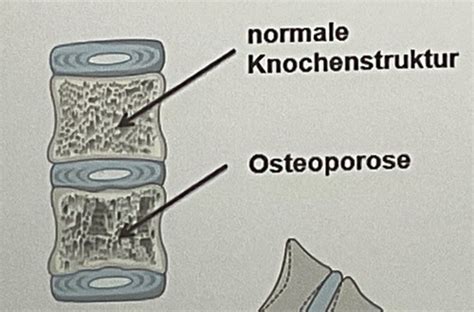 Erkrankungen Des Bewegungsapparates Osteoporose Arthrose Arthritis