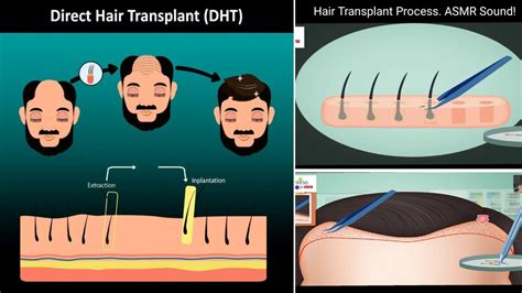 Asmr Hair Transplant Surgery Step By Step Hair Transplant Process Fue Asmr Viral Anime