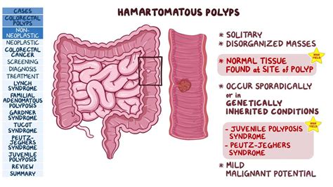 Colorectal Polyps And Cancer Pathology Review Video Osmosis