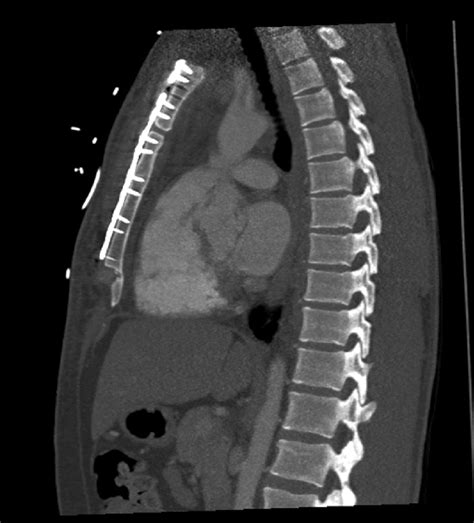 Postoperative Contrast Enhanced Computed Tomography Sagittal Image