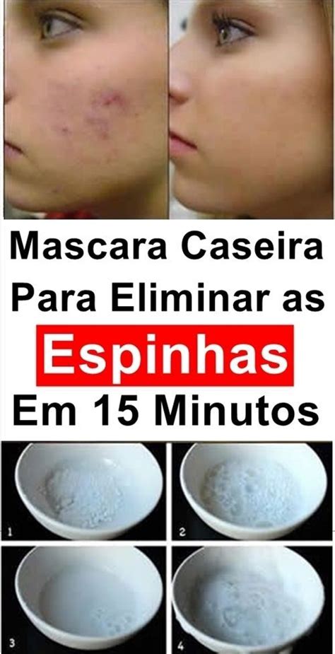 O Que Fazer Para Eliminar Cravos E Espinhas Passo A Passo