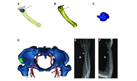 A 3d Ct Reconstruction Of The Radius Yellow And Tumor Blue White Download Scientific