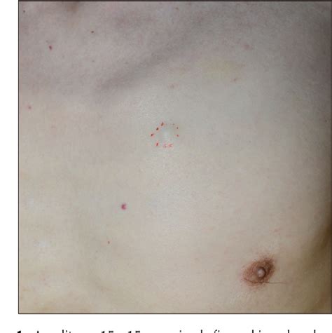 Figure From Metastatic Cutaneous Duodenal Gastrointestinal Stromal