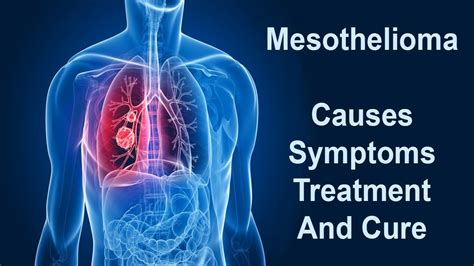 Understanding Mesothelioma Causes Symptoms Treatment And Cure Youtube