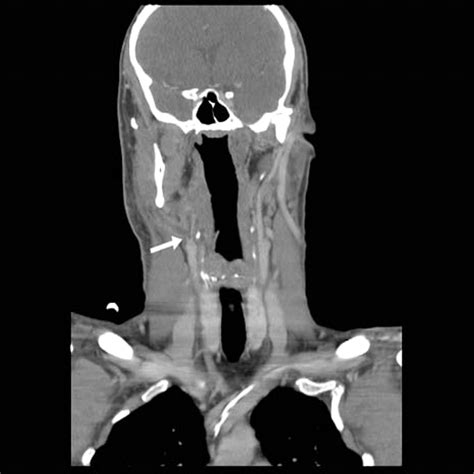 Lemierre Syndrome From Pharyngitis To Fulminant Sepsis Bmj Case Reports