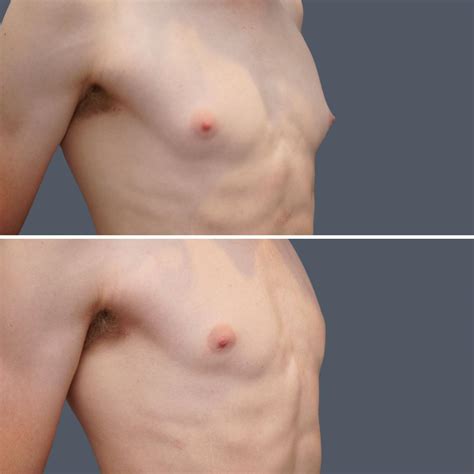 Gynecomastia Surgery Sydney Gold Coast Canberra Adelaide