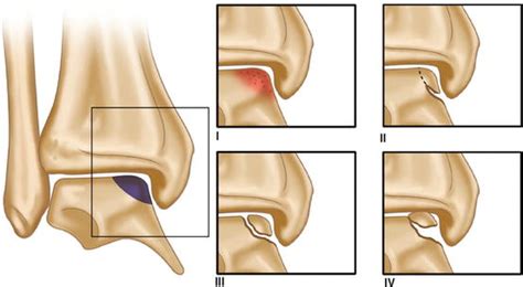 Osteochondral Lesion Classification