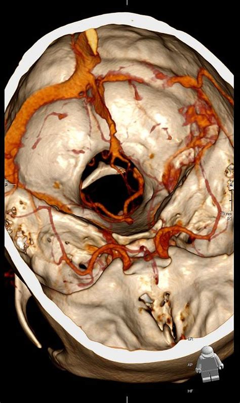 In The Thick Of It Cerebral Venous Sinus Thrombosis Precipitated By