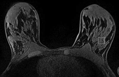 MR spectroscopy shows precancerous breast changes in women with BRCA gene