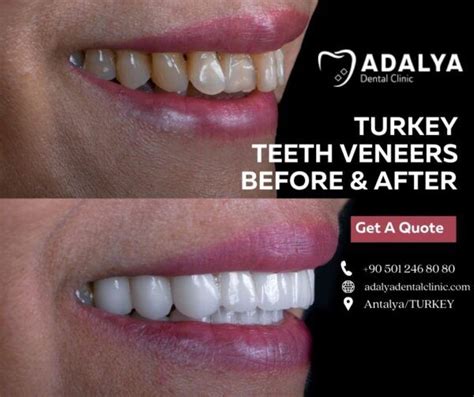 Turkey Teeth Veneers Before and After | Adalya Dental Clinic