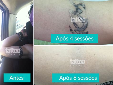 Remoção de Tatuagem a Laser Antes e Depois Tattoo Clinic