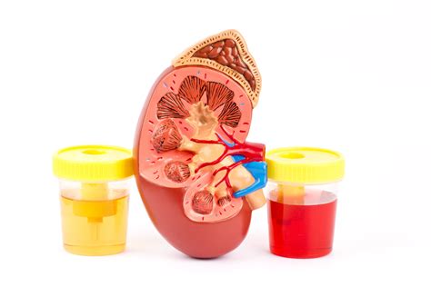 Haematuria (Blood In The Urine)