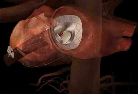 Transcatheter Mitral Valve Repair