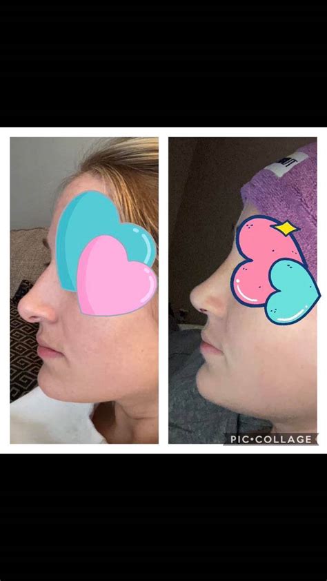 One Week Post Op Revision Rhinoplasty And Septoplasty Picture On The