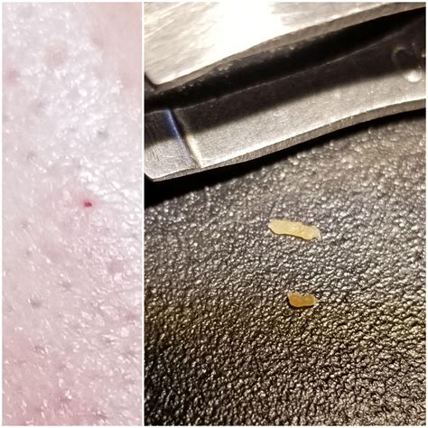 Finally got this frustrating blackhead out! Clean, empty pore and the
